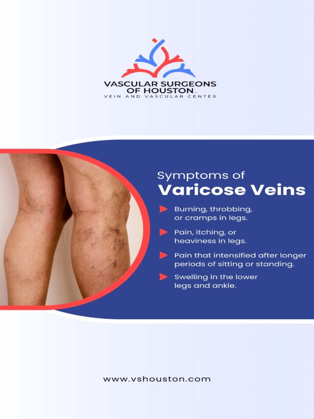 Best Treatment for Varicose Veins in Houston | Say Goodbye to Pain!