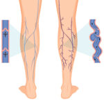 Varicose vein treatment Houston