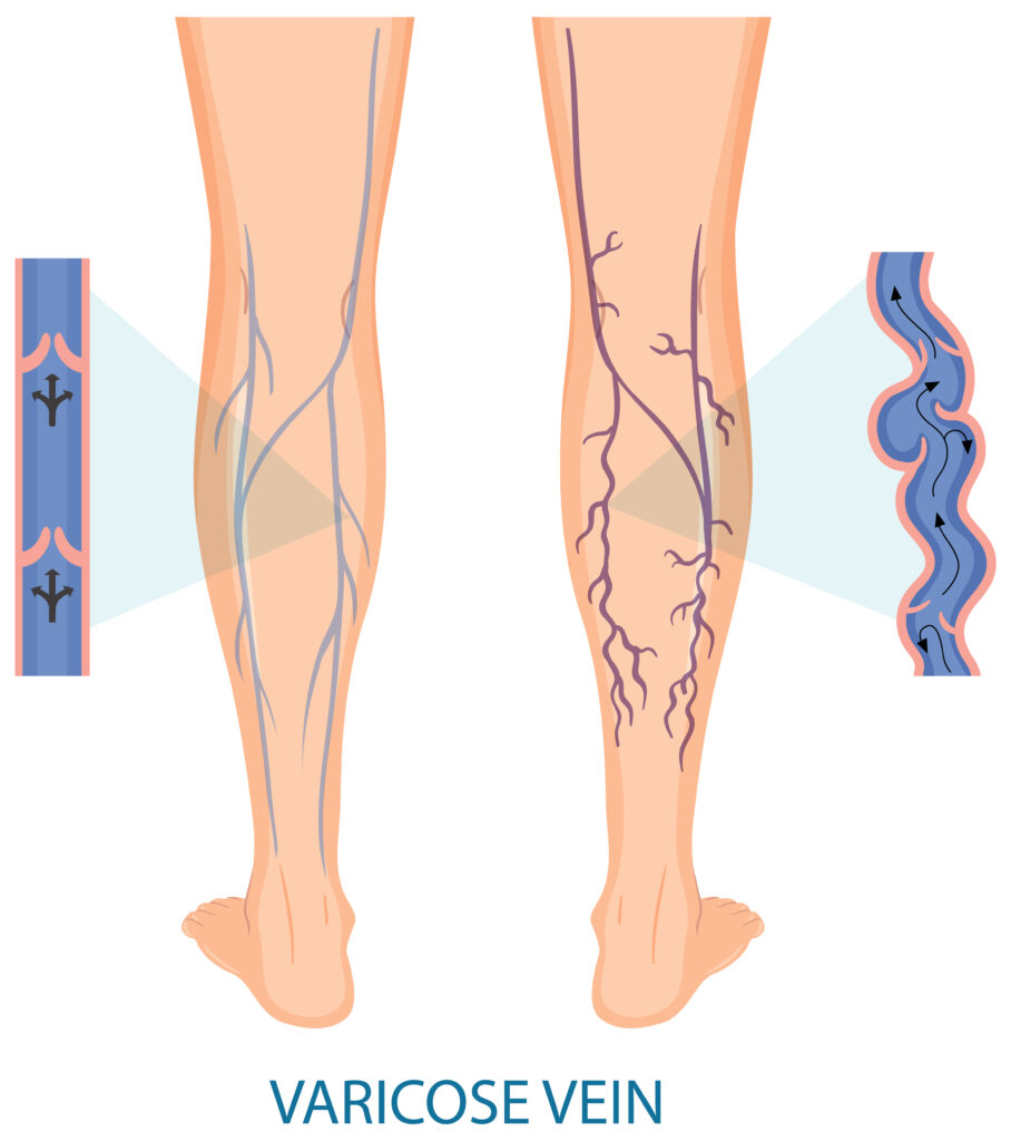 Top Solutions for Varicose Veins: Finding the Best Treatment in Houston