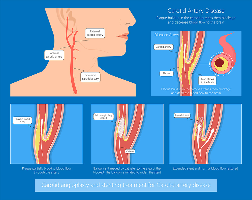 Preventing Strokes with TCAR
