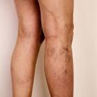 Varicose Vein Treatment 