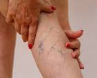 Varicose Vein Treatment 