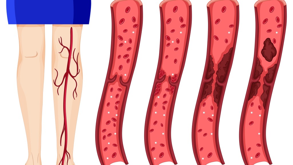 The Causes, Symptoms, and Treatments of Peripheral Venous Disease