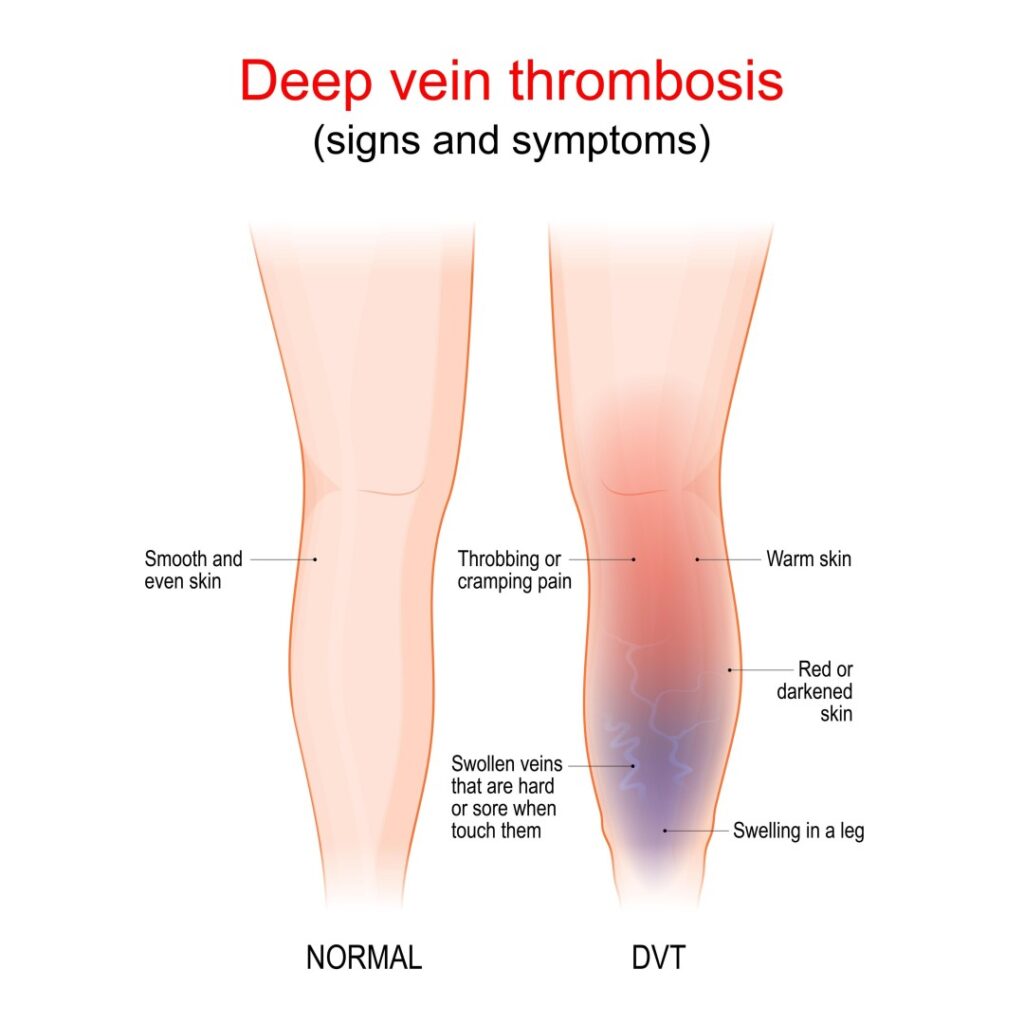 Blood Clot in Leg Treatment in Houston