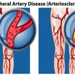 Peripheral artery disease